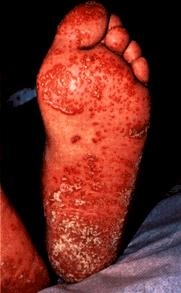 image of Keratoderma blennorrhagicum: classic