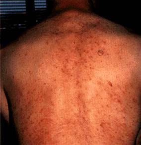 image of Eosinophilic folliculitis