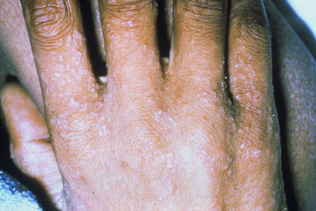 image of Scabies: with interdigital involvement