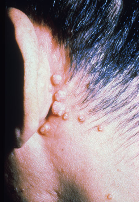 image of Molluscum contagiosum