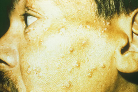 image of Molluscum contagiosum