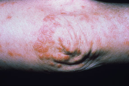 image of Psoriasis