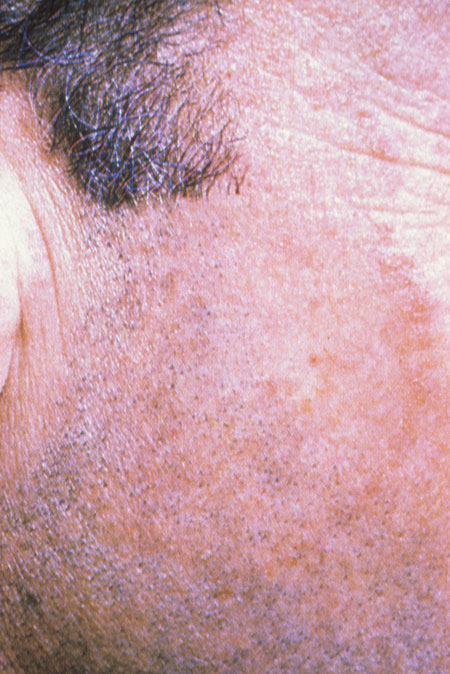 image of Dermatophyte: face