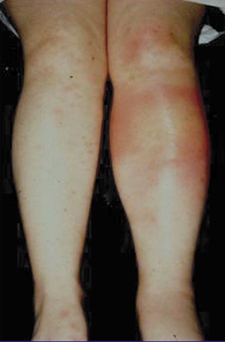 image of Erythema nodosum