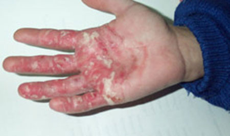 image of Candidiasis: cutaneous