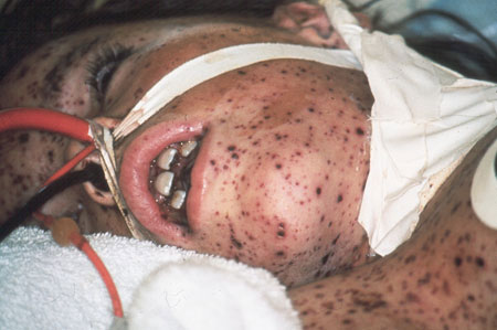 image of Varicella-zoster: hemorrhagic infection