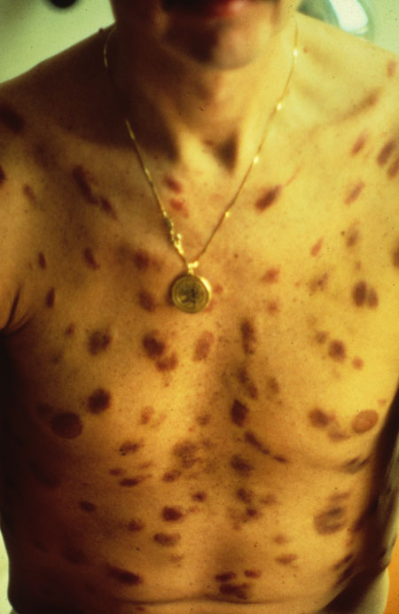 image of Kaposi sarcoma: chest