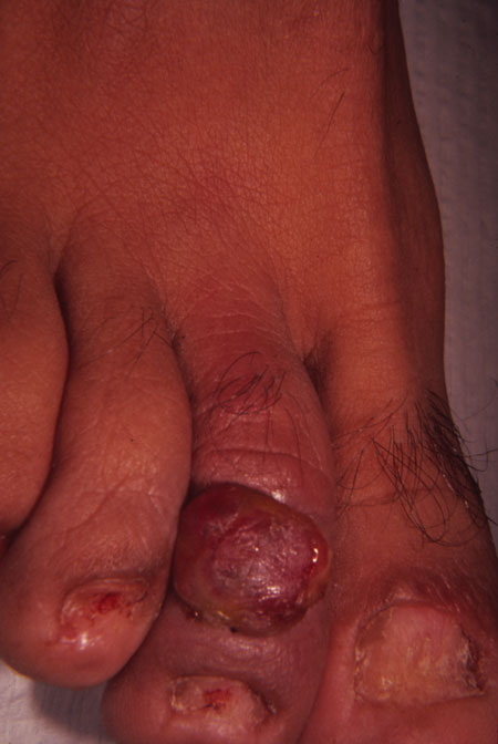 image of Kaposi sarcoma: foot