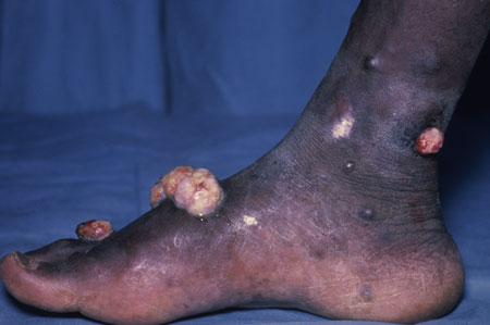 image of Kaposi sarcoma: foot