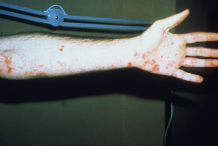 image of Herpes simplex