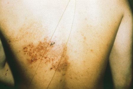 image of Herpes simplex