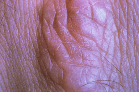 image of Granuloma annulare