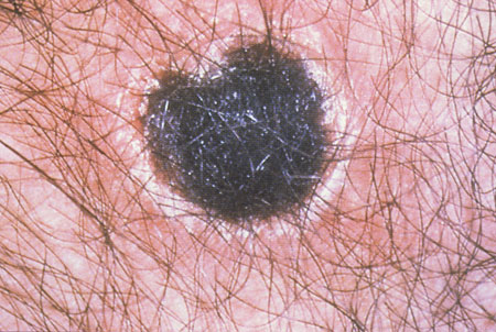 image of Ecthyma