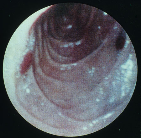 image of Kaposi sarcoma: gastrointestinal lesion seen on endoscopy