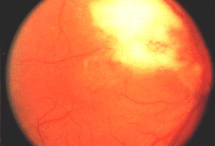 image of Toxoplasmic retinochoroiditis