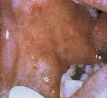 image of Thrush: erythematous