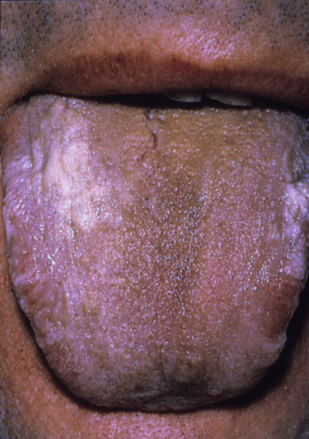 image of Coated tongue