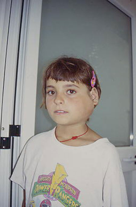 image of Parotitis: suppurative