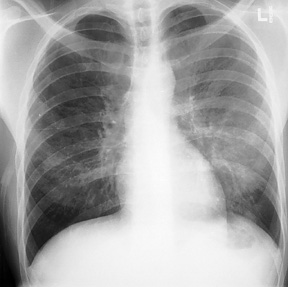 image of  Pneumocystis jiroveci
                    : chest X ray with unilateral granular opacities
                