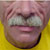 thumbnail image of Lipoatrophy: facial fat loss