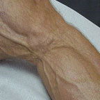 thumbnail image of Lipoatrophy: fat depletion of leg