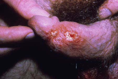 image of Herpes simplex: genital
