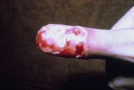image of Herpetic whitlow