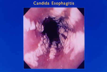 candida esophagitis