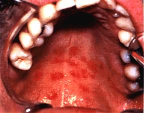 Oral Thrush Hiv