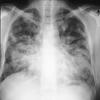 thumbnail image of Kaposi sarcoma, pulmonary: chest X ray