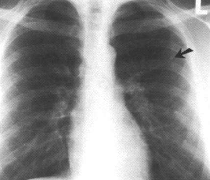 image of Non-Hodgkin lymphoma: initial chest radiograph